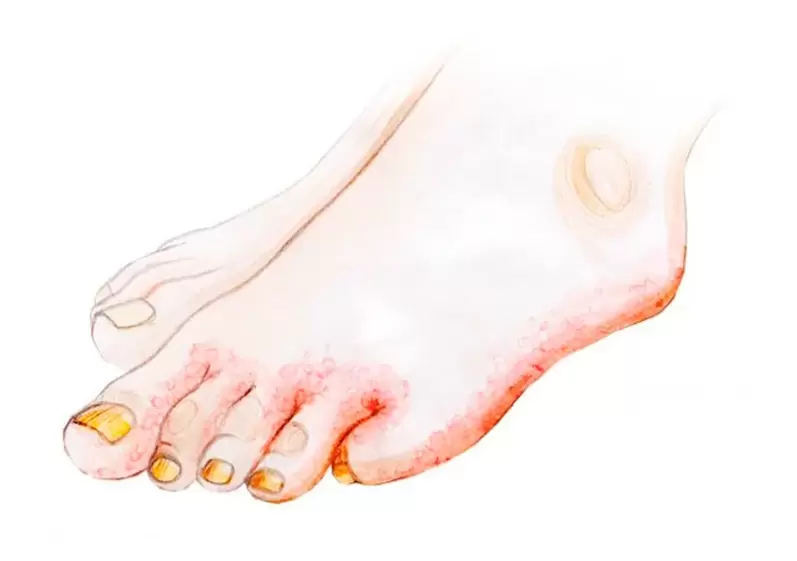 Fungus on toes and how to apply Zenidol cream