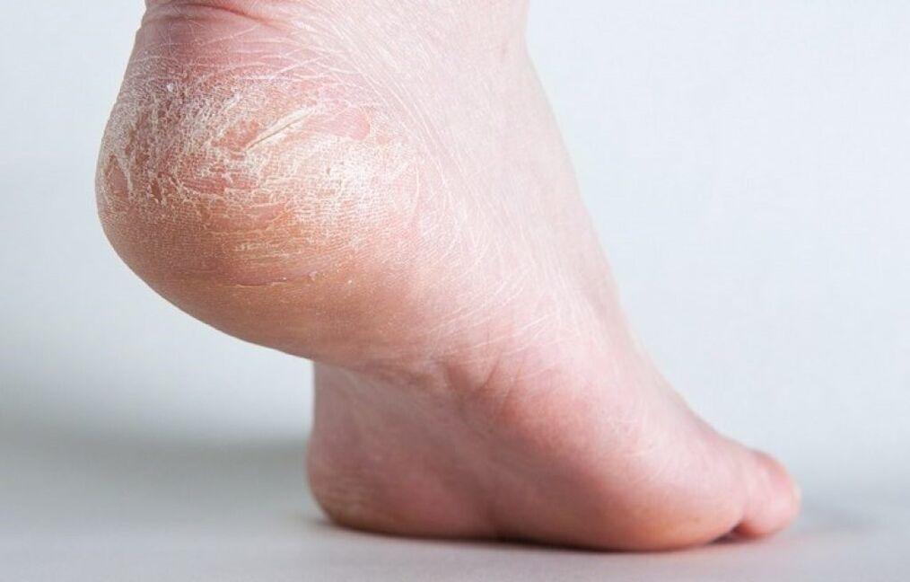 how to treat skin fungus on leg