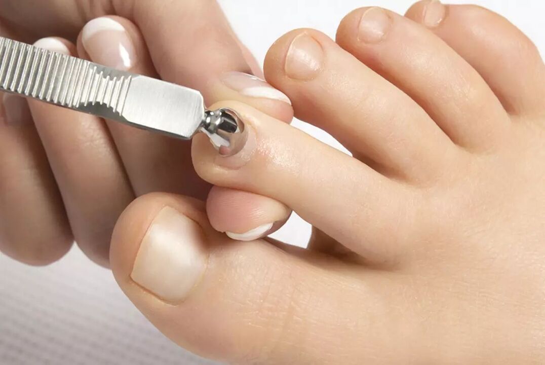What helps against nail fungus