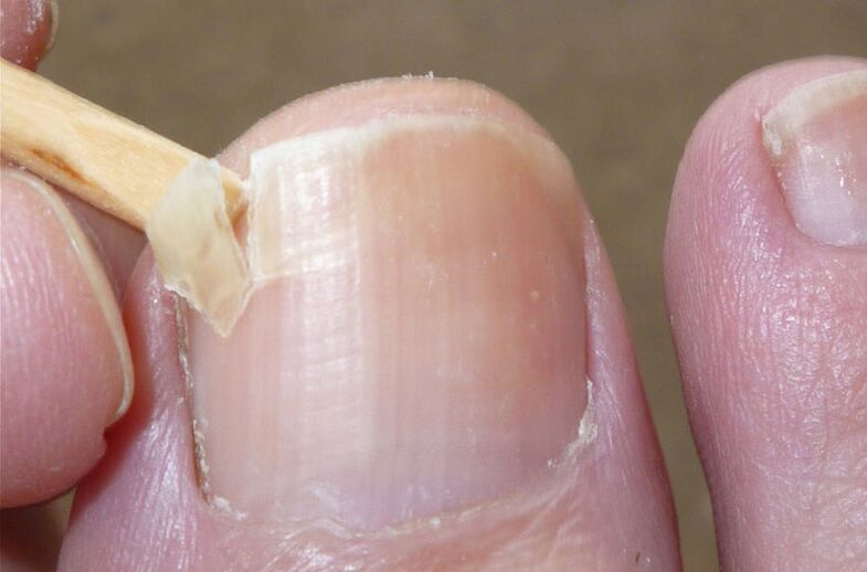 Damaged nails are a risk factor for a fungal infection