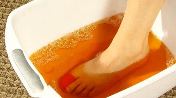 Iodine bath for athlete's foot