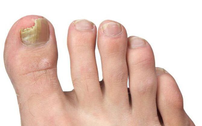 Mushroom on the thumb of the foot