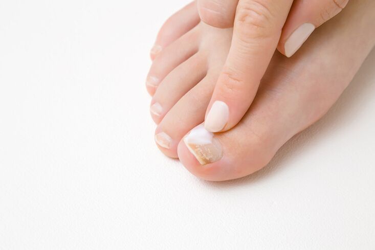 Fingel treatment with ointment from the mushroom