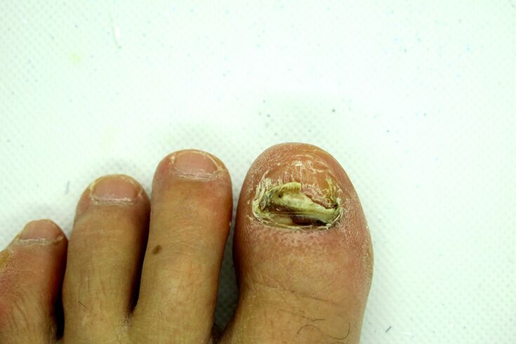 Fingernail fungus - heavy stage