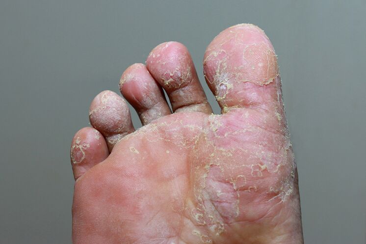 Heavy stage of the foxgust of mycosis