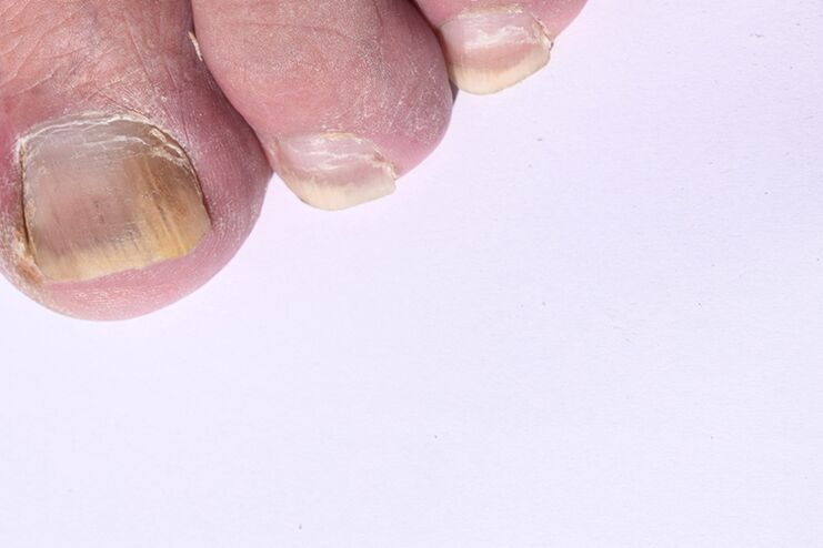 The initial phase of mycosis of nails on the legs