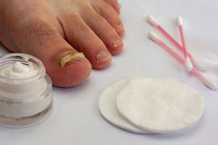 Treatment of finger mushroom with cream from the mushroom
