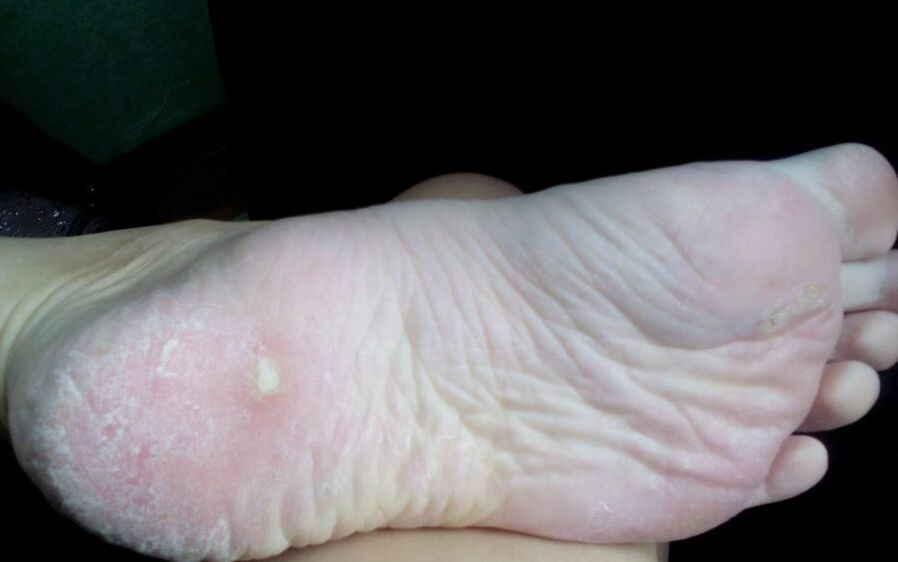 What the fungus looks like and manifests itself