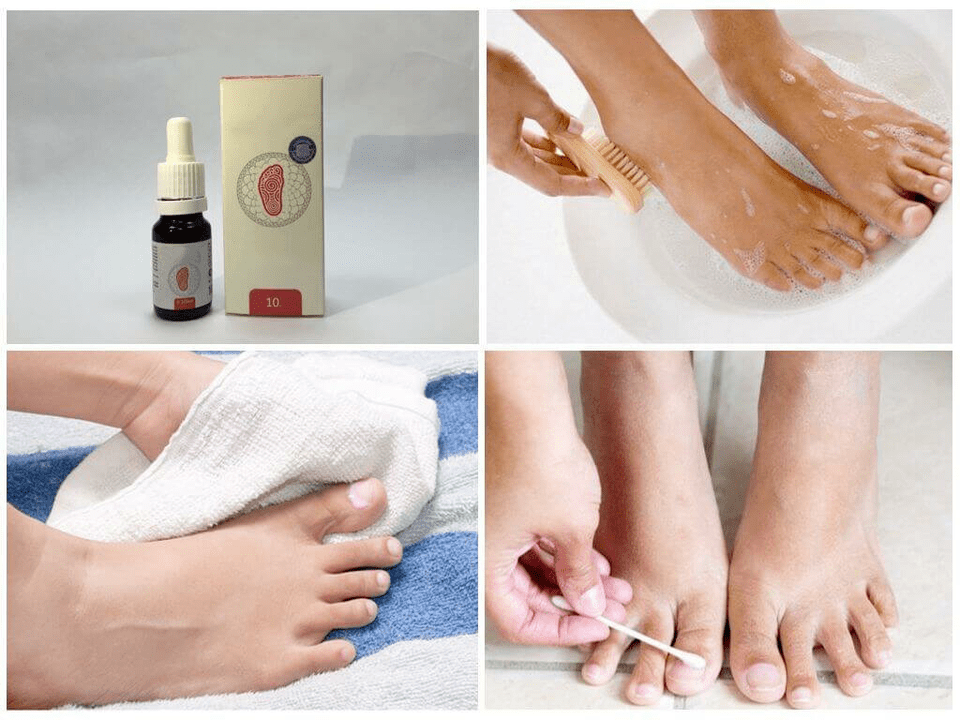 Various remedies for athlete's foot