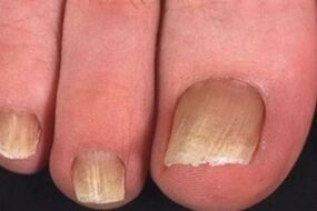 Fungal infection of the toenail