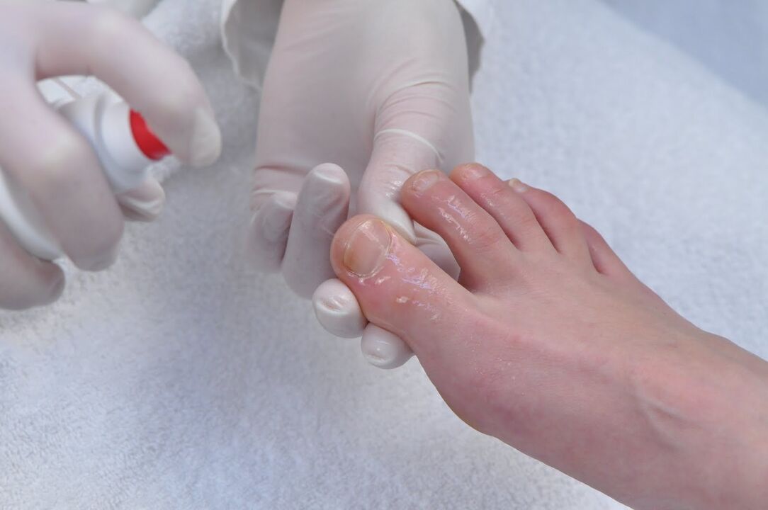 Treatment of toenails against fungus