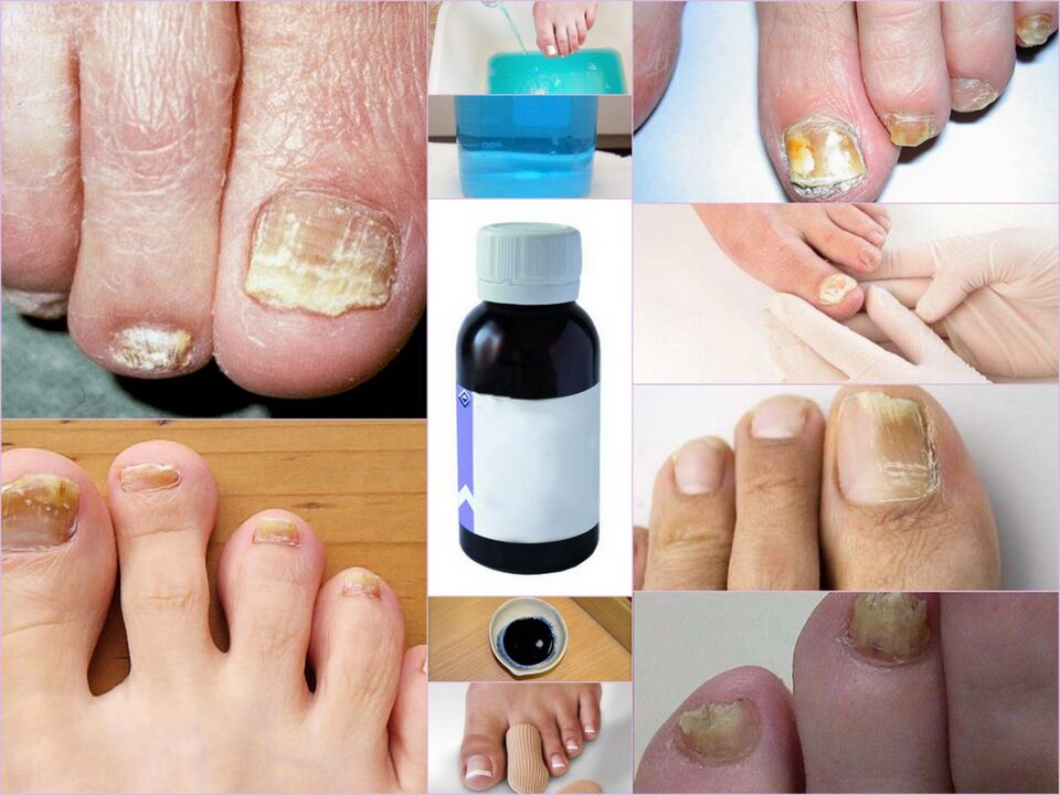 Medication for toenail fungus