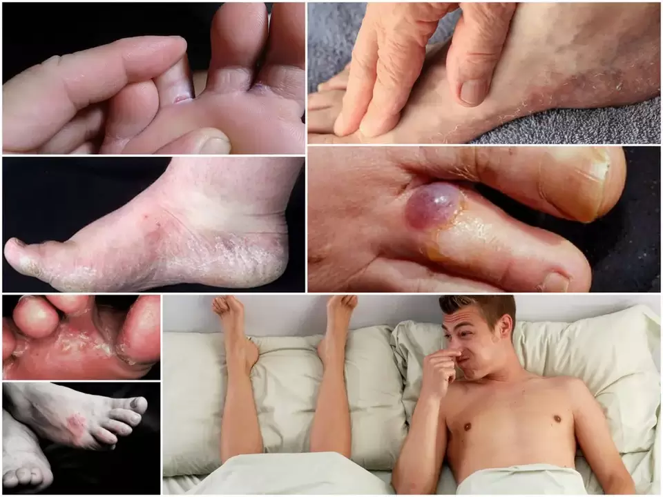 Main symptoms of athlete's foot