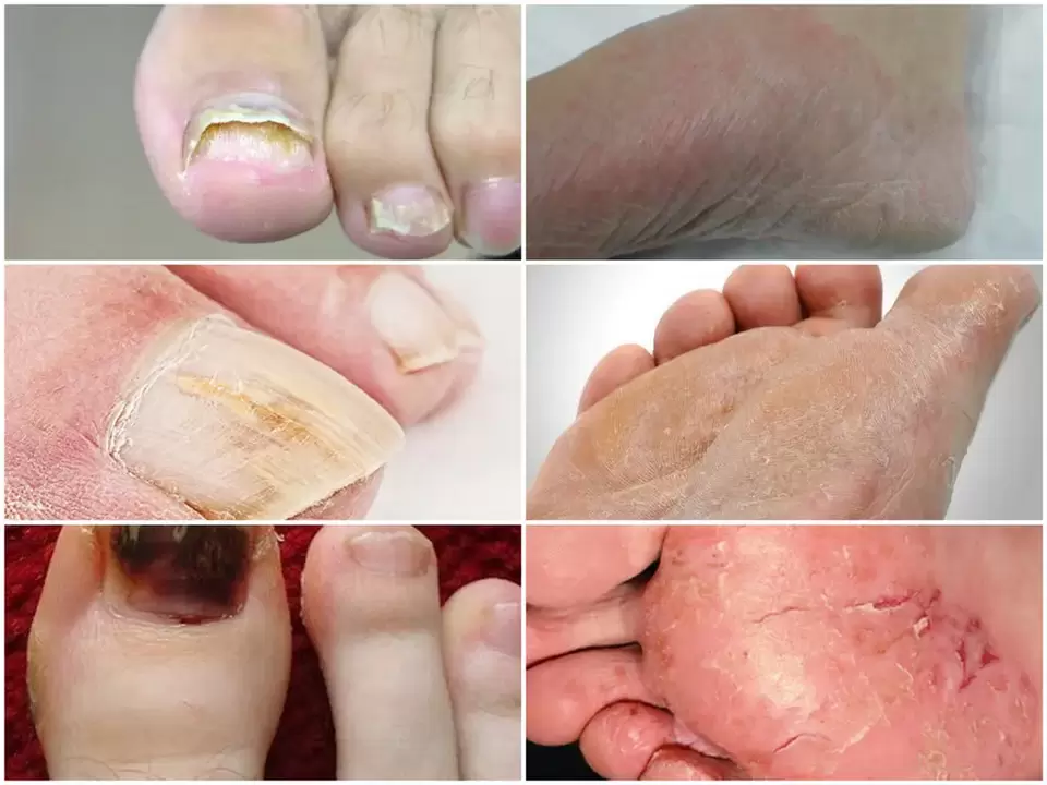Manifestations of fungus on the feet caused by various pathogens