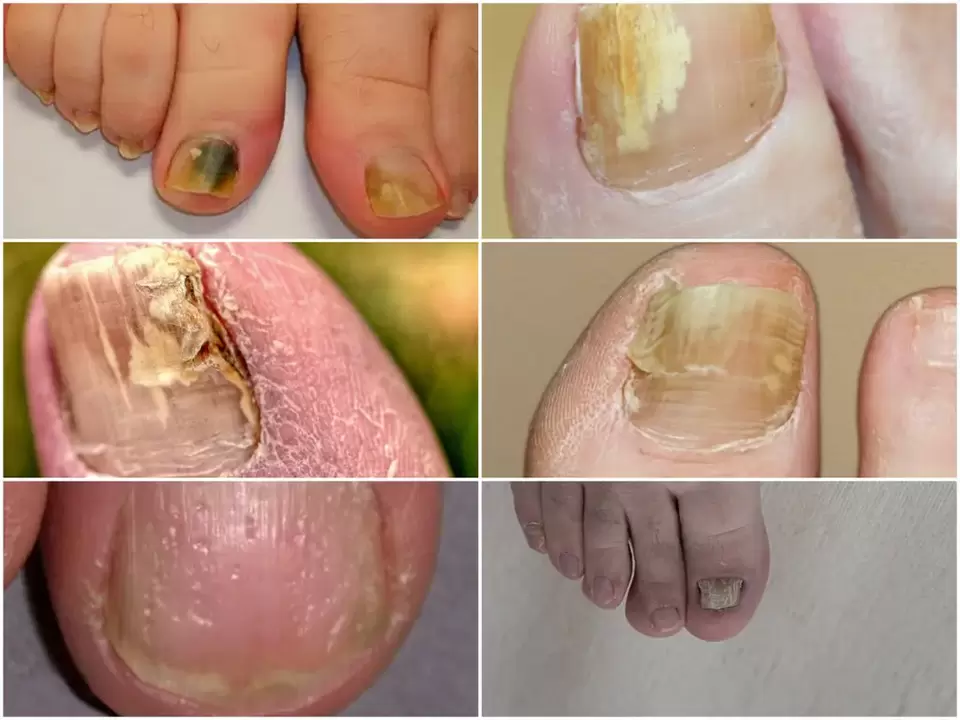 Symptoms of onychomycosis – changes in the color and structure of the nails
