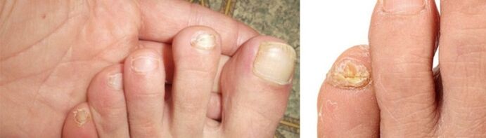 Photo of fungal manifestations on toenails