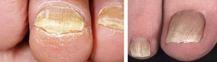 Damage to the nails from a fungal infection