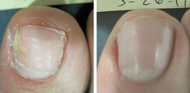 before and after treatment for nail fungus