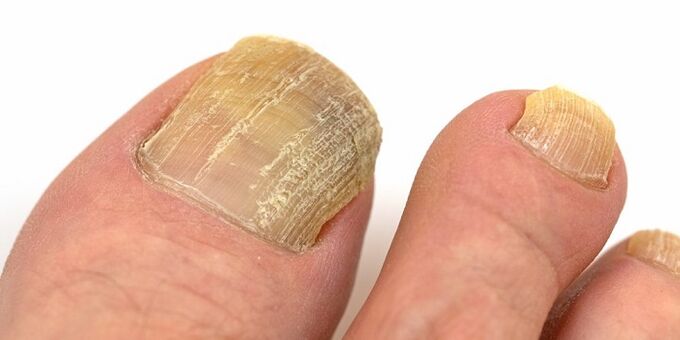 Damage to the nails with advanced fungal infection