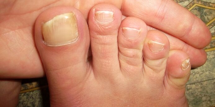 Damage to the toenails with fungus