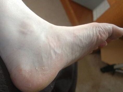 Peeling of the foot of the leg as a sign of a fungal infection