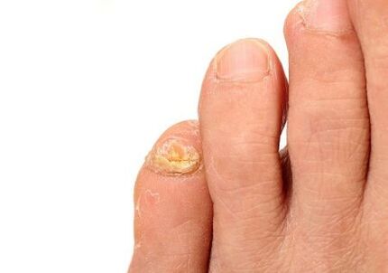 Fungal dermatophytes attack the nail